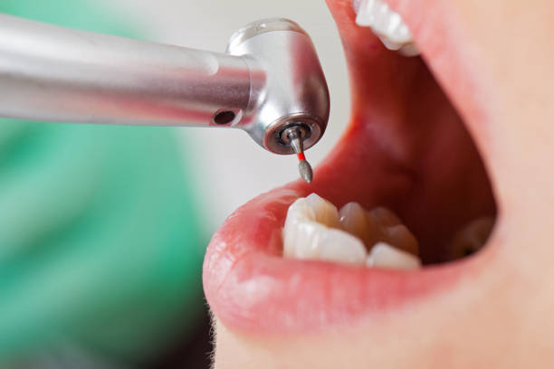 Best Emergency Dentist for Lost Fillings or Crowns in Panthersville, GA